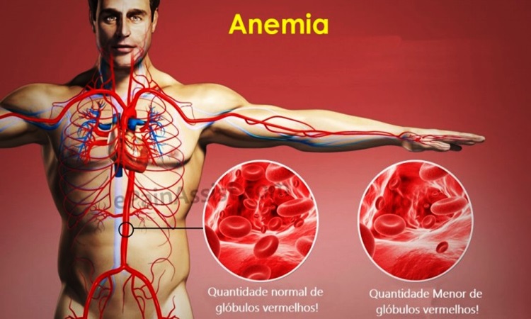 SAÚDE:  Anemia – O que é, Causas, Sintomas e Tratamentos