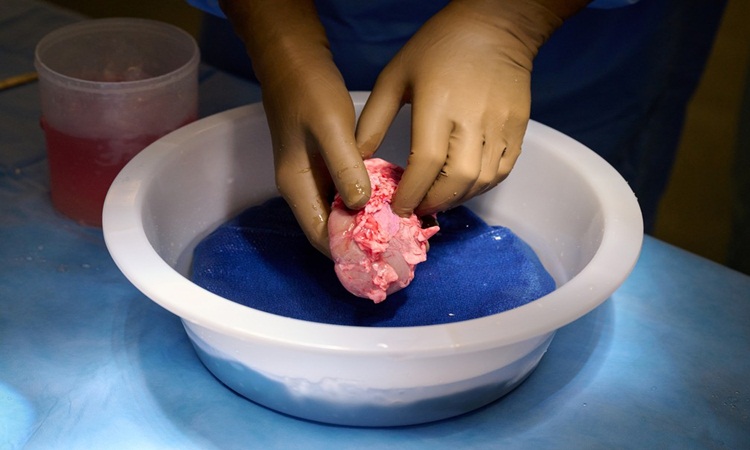 Em feito inédito, cirurgiões dos EUA testam com sucesso transplante de rim de porco em humano
