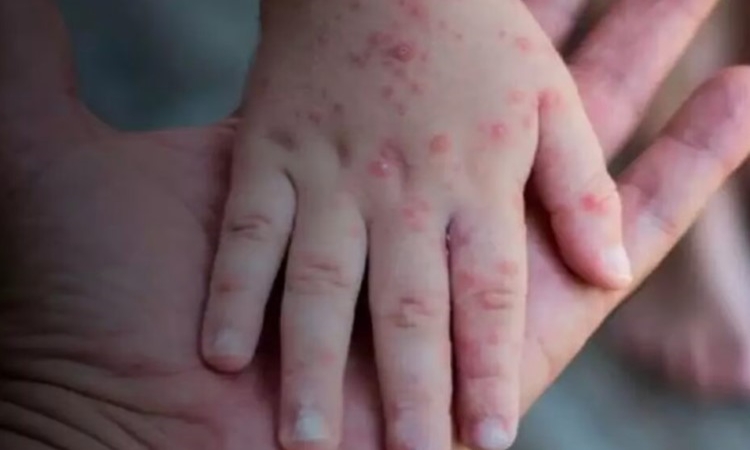 GO: Criança de 7 anos é o segundo caso confirmado de varíola dos macacos, em Jaraguá
