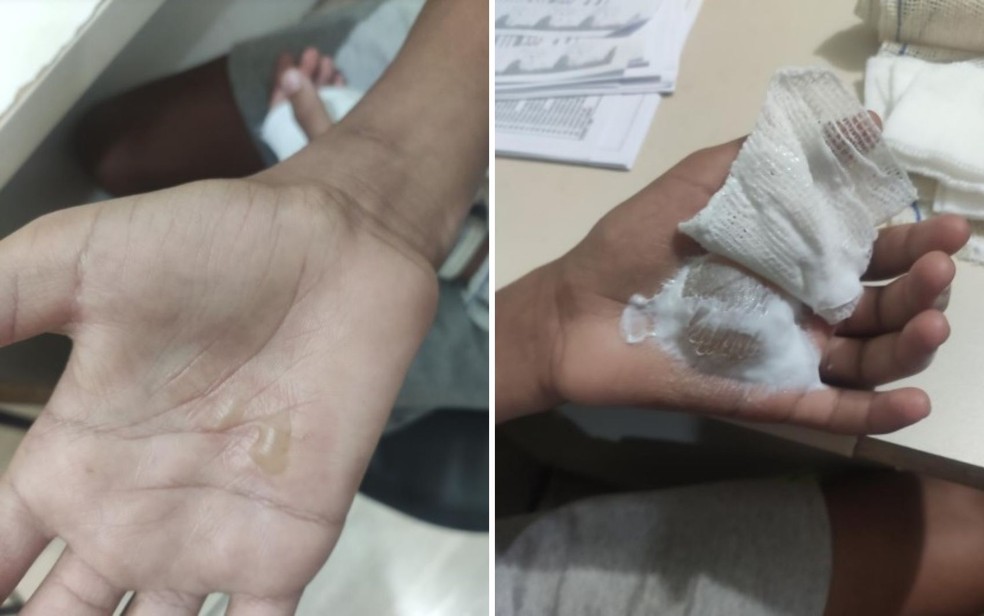 GO: Mãe e madrasta são indiciadas por torturar menino ao queimá-lo com colher quente